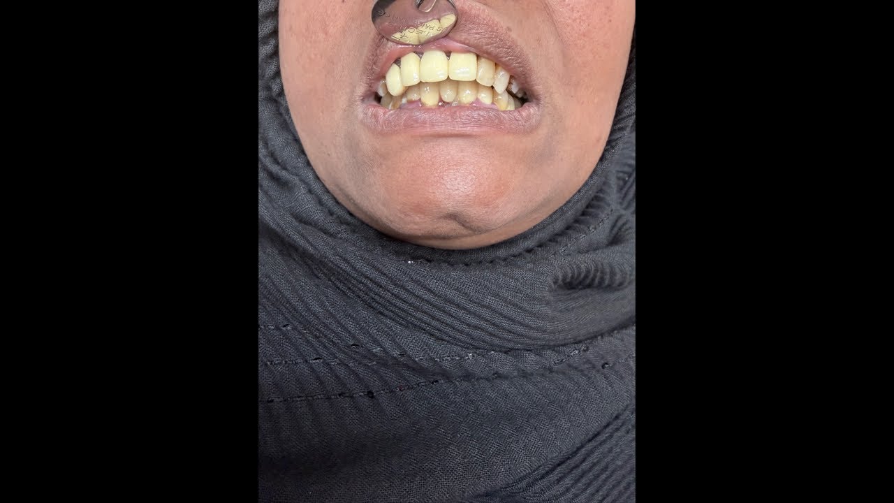 দাঁত বাঁধানোর ১২ বছর পরও ভালো আছেন আলহামদুলিল্লাহ বিস্তারিত লাইবে দেখু