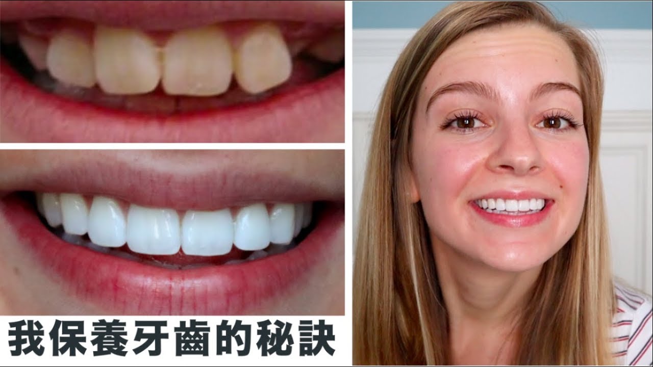 【如何擁有白牙✨】美國牙科保險竟然這麼貴 !? 美國人為什麼這麼重視牙齒的保養？