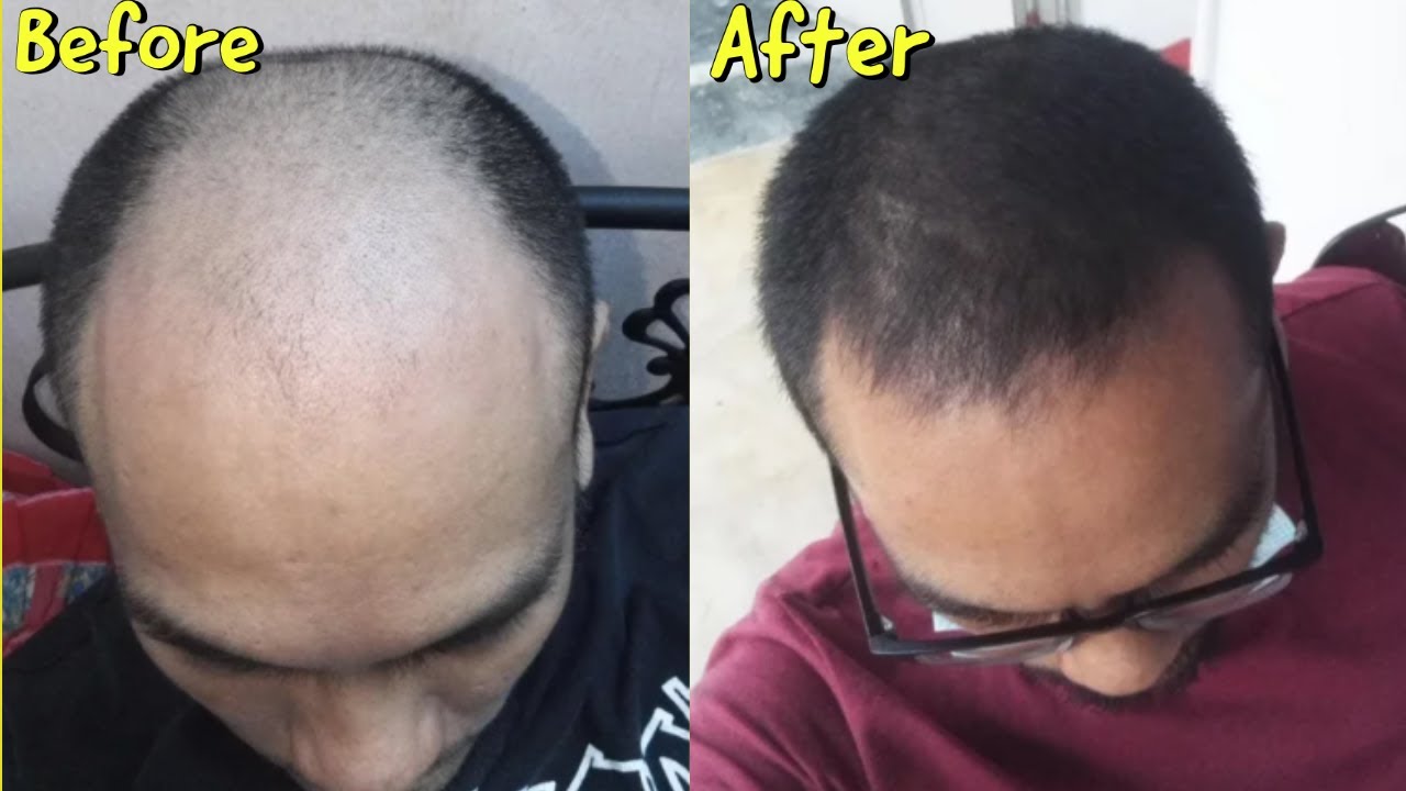 *UNBELIEVABLE* MICRONEEDLING/DERMA ROLLING RESULTS TO STOP BALDING AND HAIR LOSS!