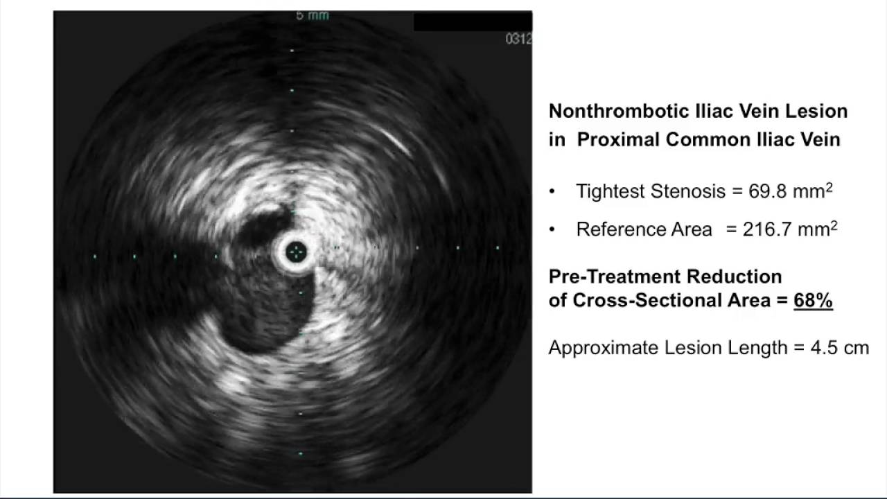 IVUS-Guided Deep Venous Stenting