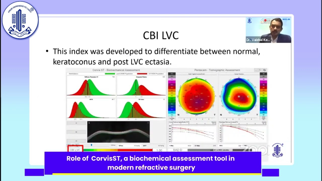 Role of  CorvisST, a biochemical assessment tool in modern refractive surgery - Dr. Vaishal Kenia