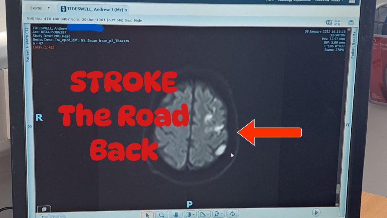 Andrew's Journey Post Stroke