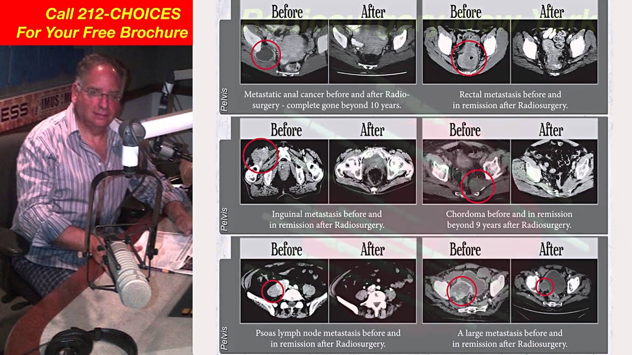 Dr. Gil Lederman's Radiosurgery Show! Podcast 22 Part FOUR