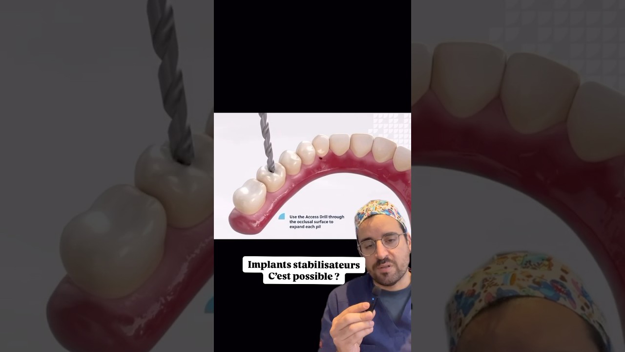 Implants stabilisateurs : la cl&eacute; pour une proth&egrave;se viss&eacute;e qui ne bouge plus !