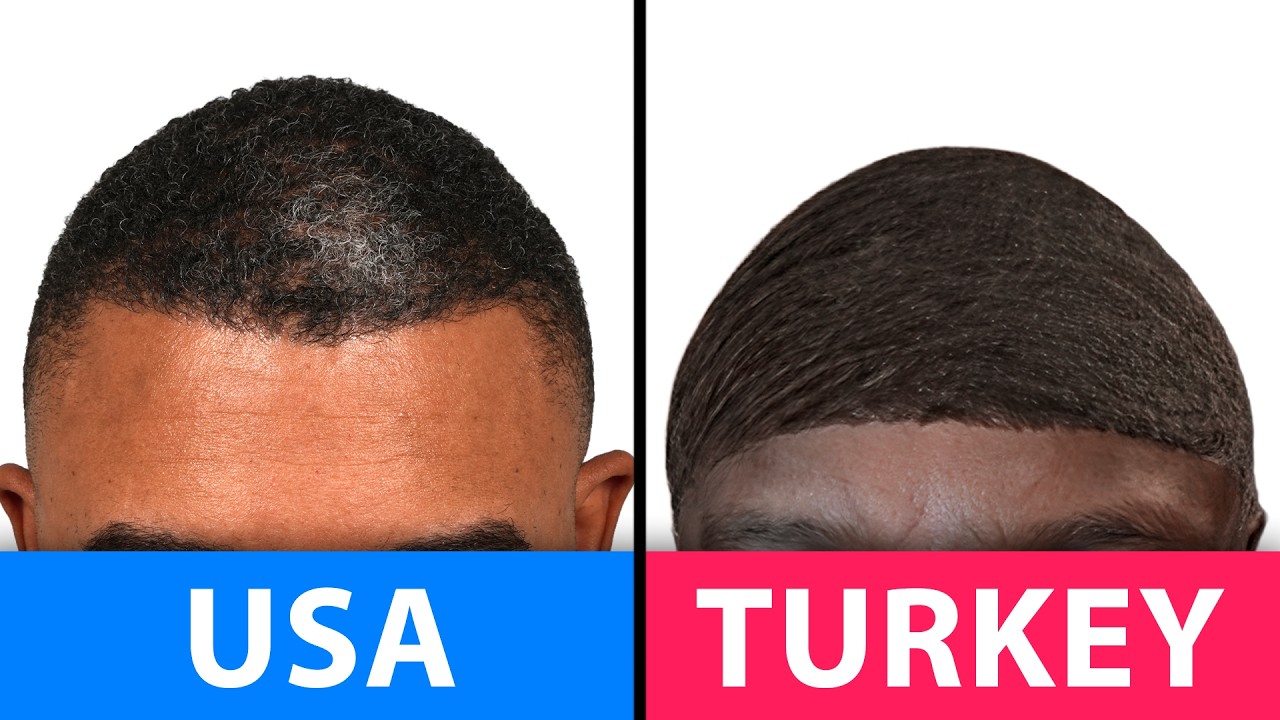 Is Turkey Really BETTER For A Transplant? | Hair Surgeon Reacts