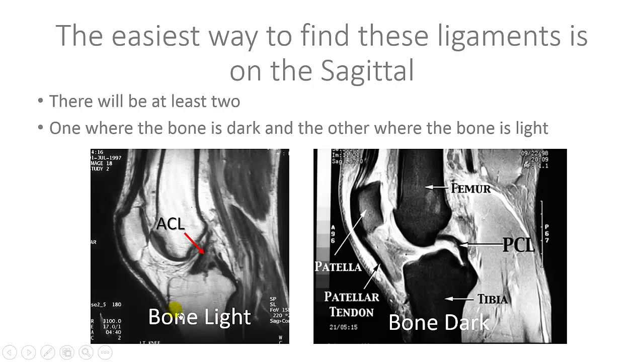 Read Knee MRI ACL and PCL - Help with Reading MRI