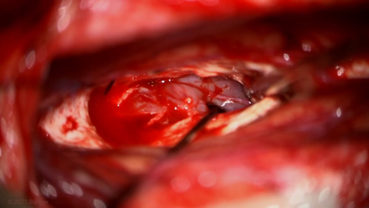 Posterior Transcallosal-Interforniceal Approach for Resection of a Pineoblastoma