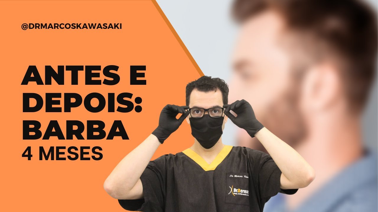 Antes e depois: barba (4 meses)