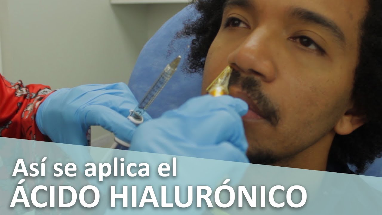 Cómo se aplica el ÁCIDO HIALURÓNICO en la CARA (Surcos nasogenianos) 💉