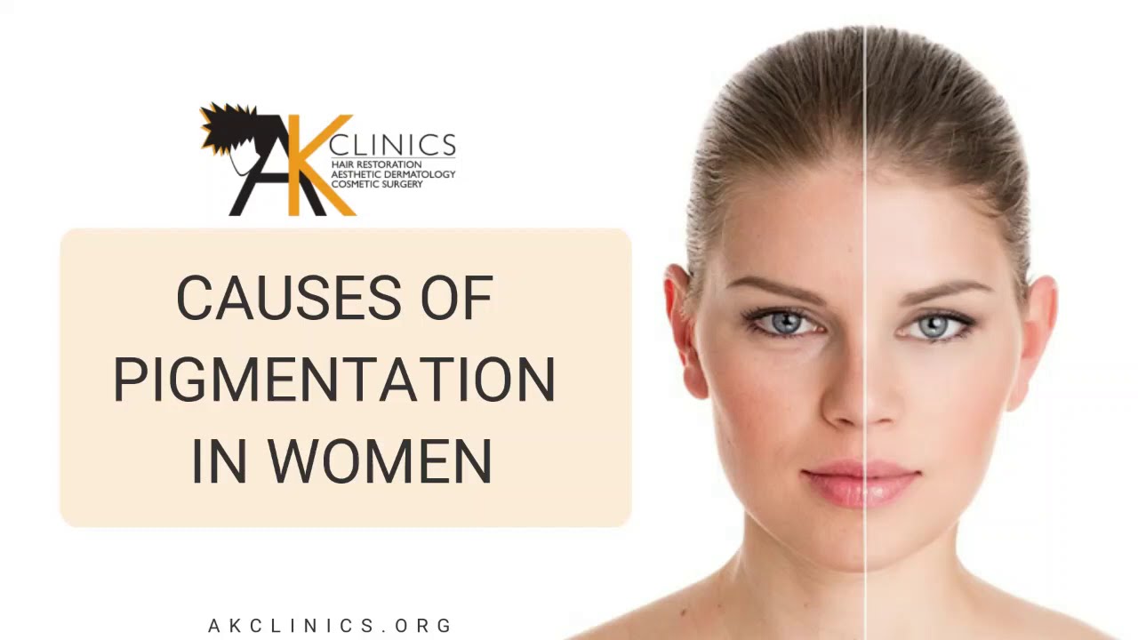 Face Pigmentation || Main Causes of Pigmentation in Women - Dr Aman Dua