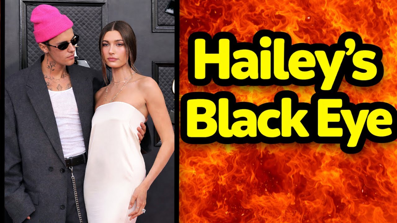 Hailey Bieber's Bruised Eye Brings Unwanted Heat To Justin