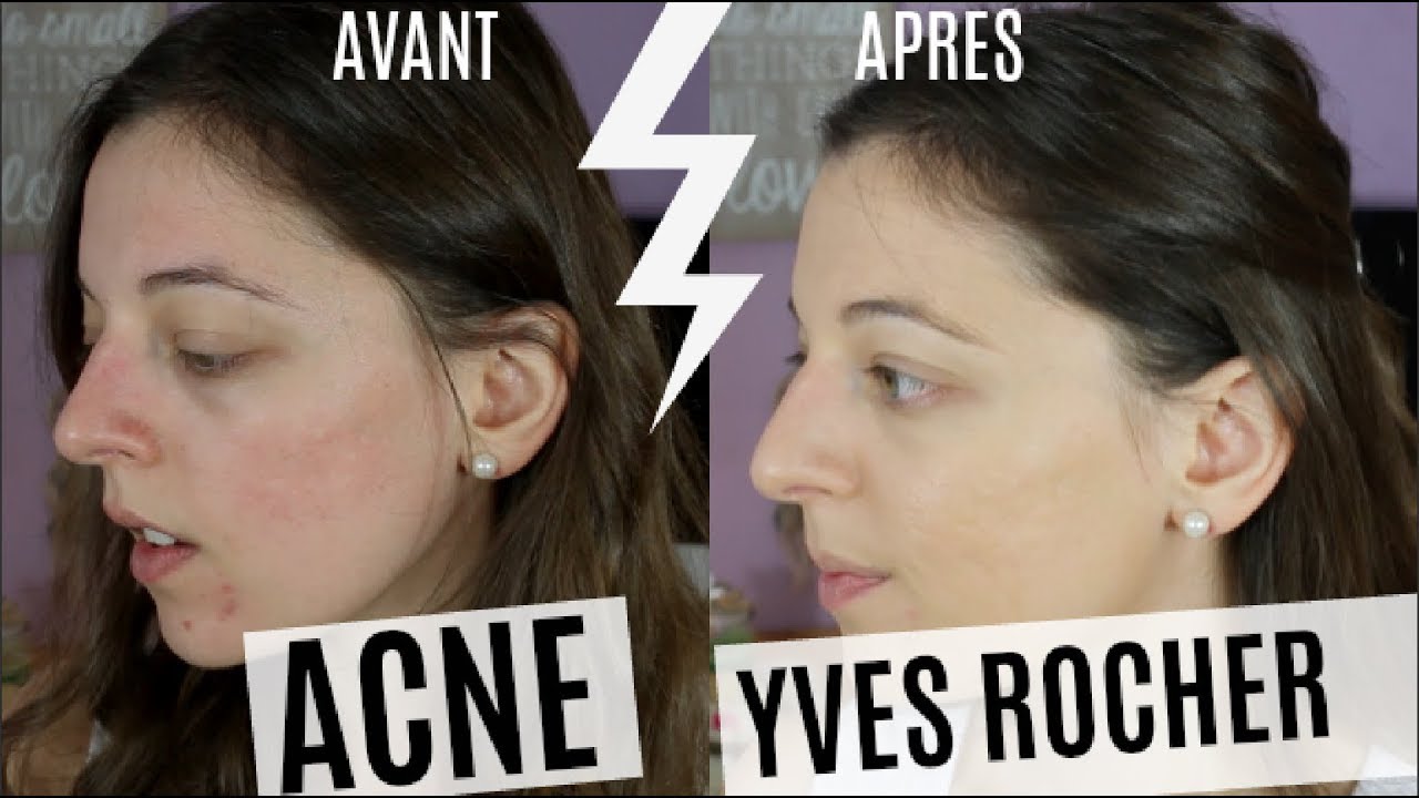 ACNE : Une journée avec le FDT YVES ROCHER (1ere impression/ Zéro Défaut)