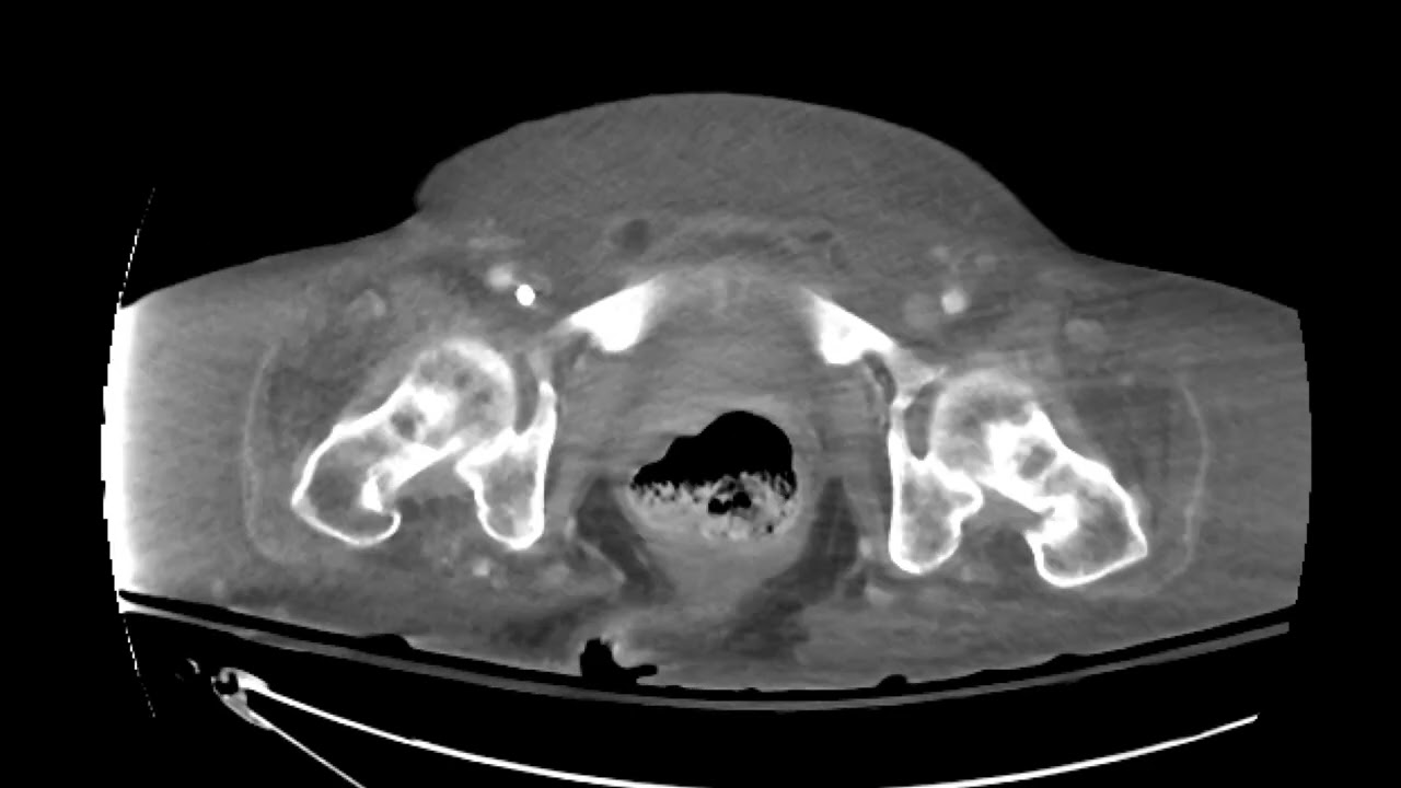 Perforated appendicitis