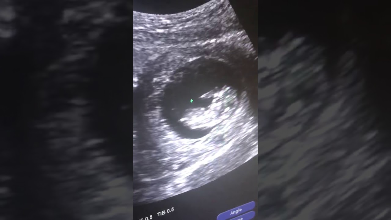 10 weeks pregnant ultrasound