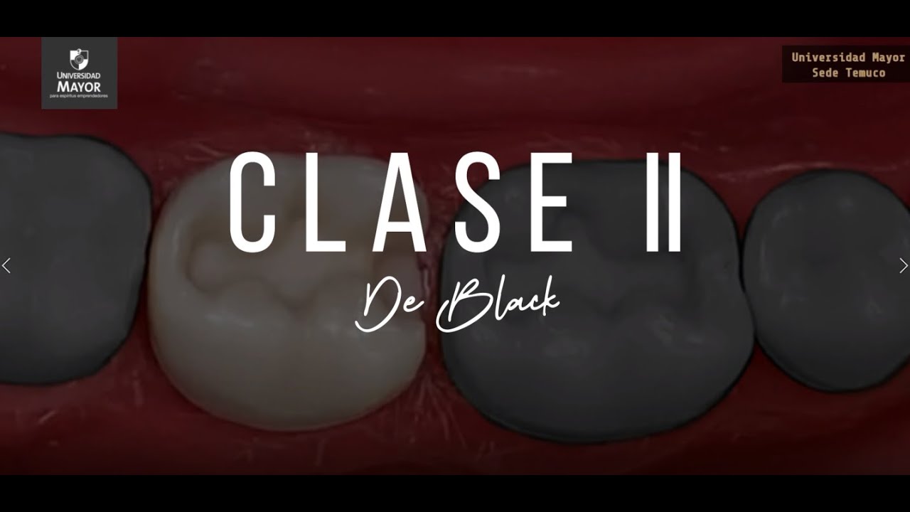 Preparación clase II de Black | Paso a paso