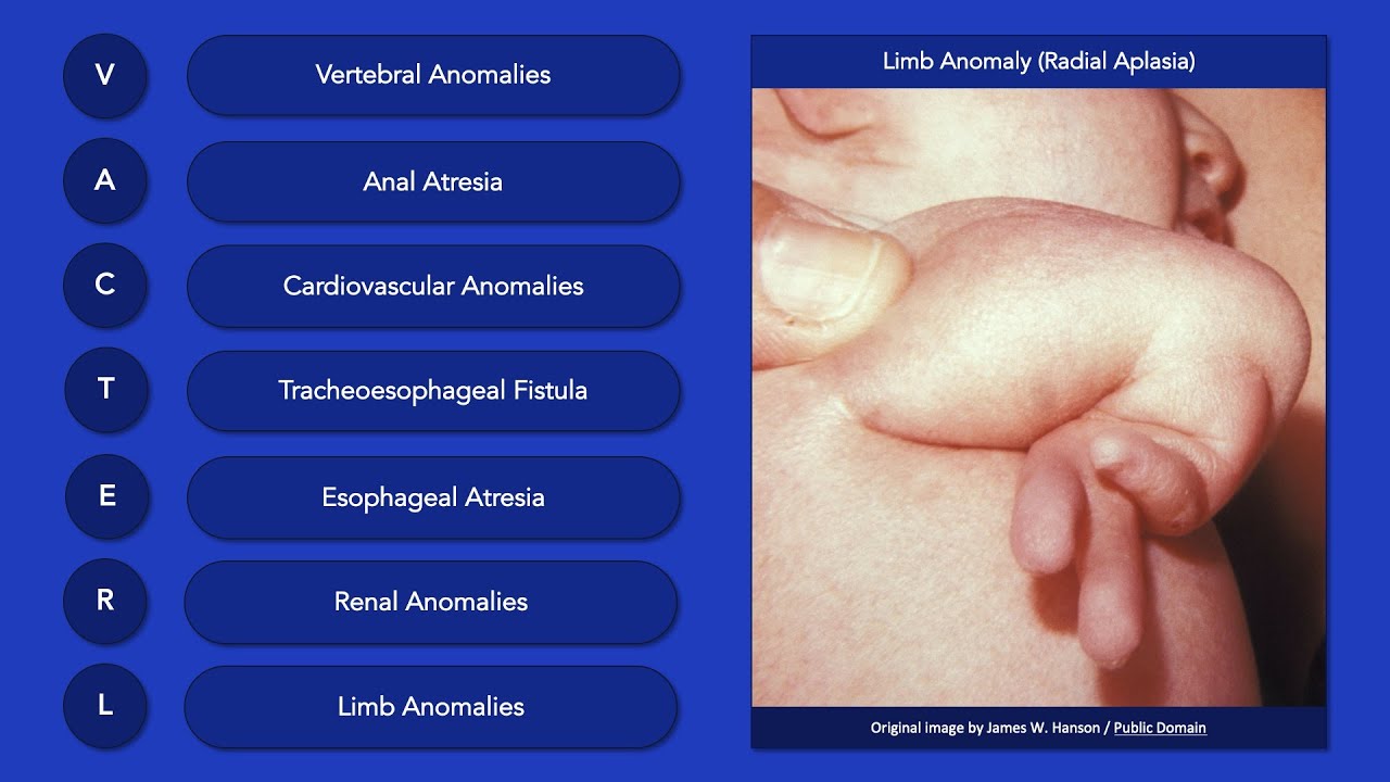 VACTERL Association: Clinical Features