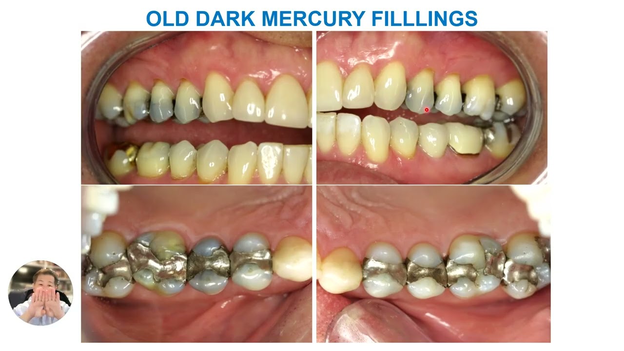 Enhancing Dental Aesthetics with Modern Restorative Materials