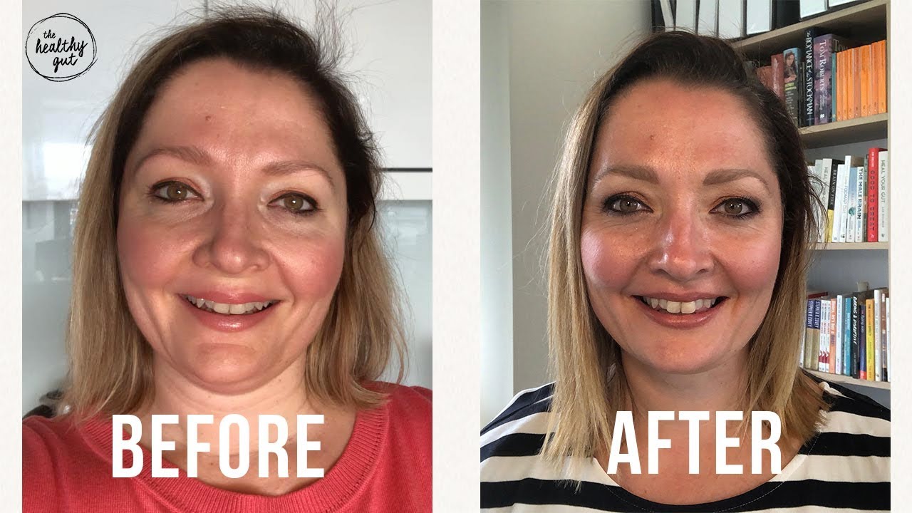 14 Days on The Elemental Diet for SIBO: Before and After Results with Rebecca Coomes