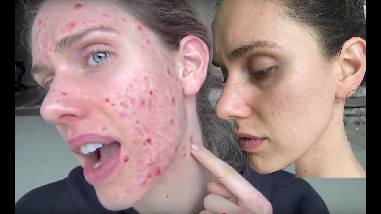 HOW GOING VEGAN HELPED CLEAR MY ACNE