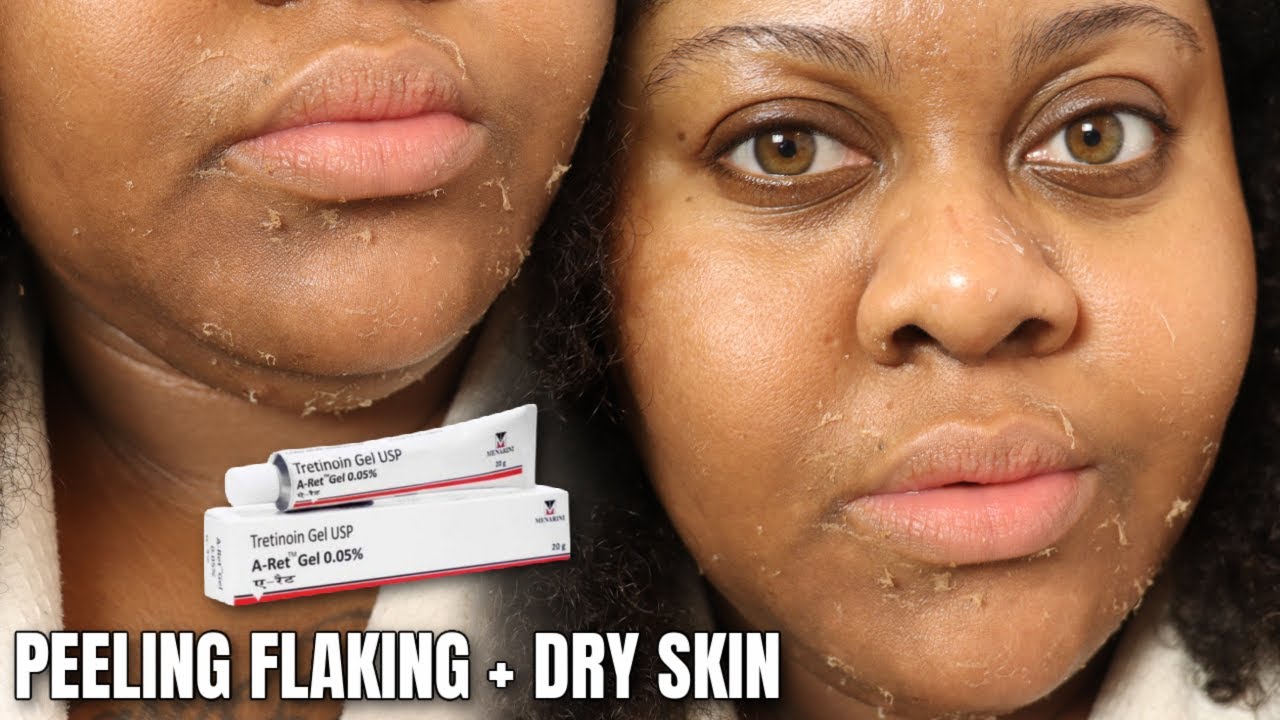TRYING 1% TRETINOIN FOR 1 WEEK FOR DARK SPOTS + TEXTURE