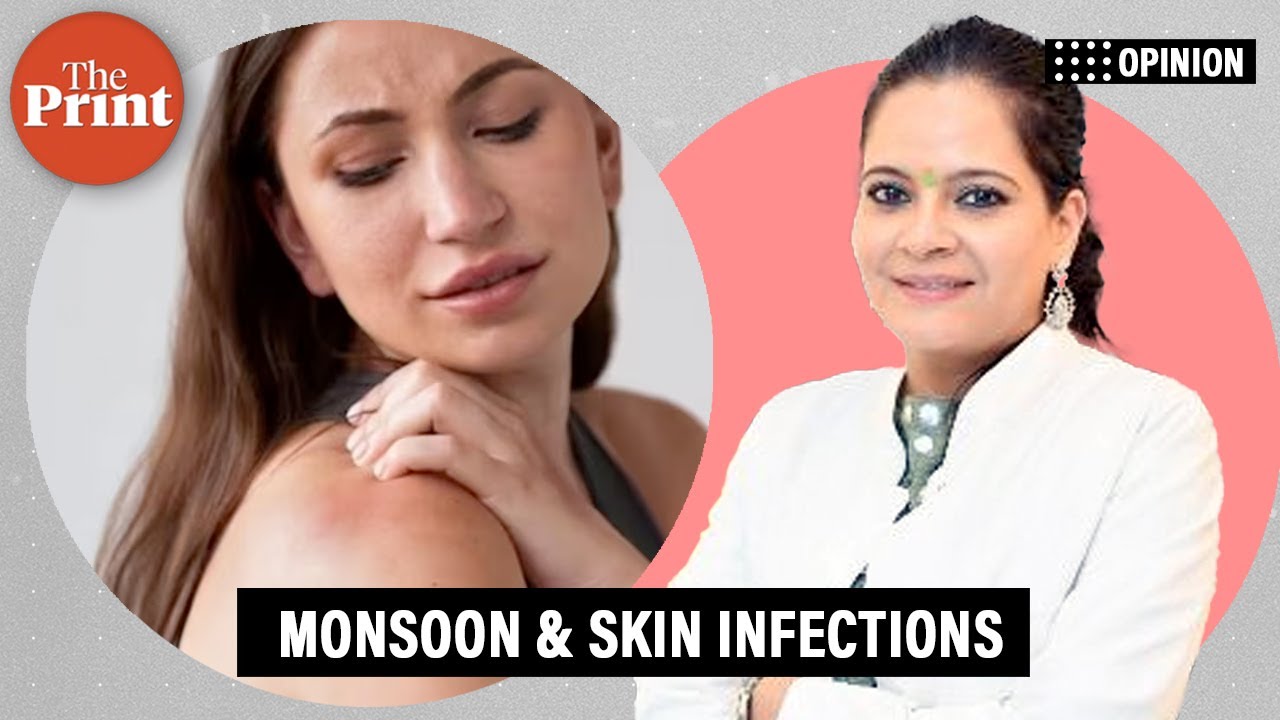 Skin infections, allergies & outbreaks: Why you need to be careful during monsoon