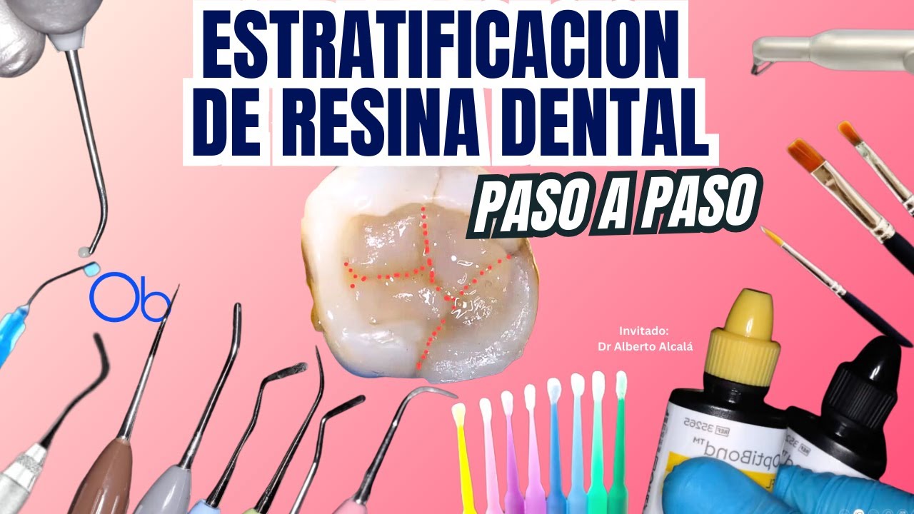 Estratificaci&oacute;n de Resina Dental paso a paso: resinas, material, instrumental y casos cl&iacute;nicos