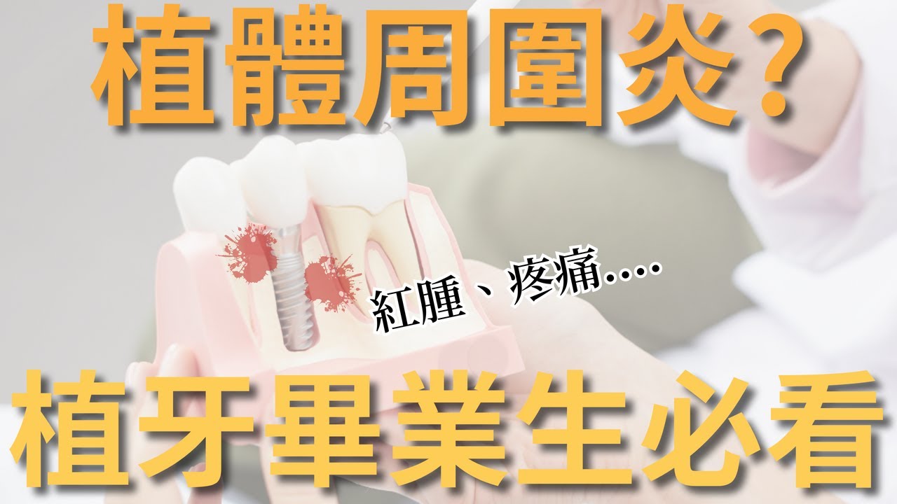 【植牙後不可不知】預防植體周圍炎的黃金絕招|沙鹿威登牙醫