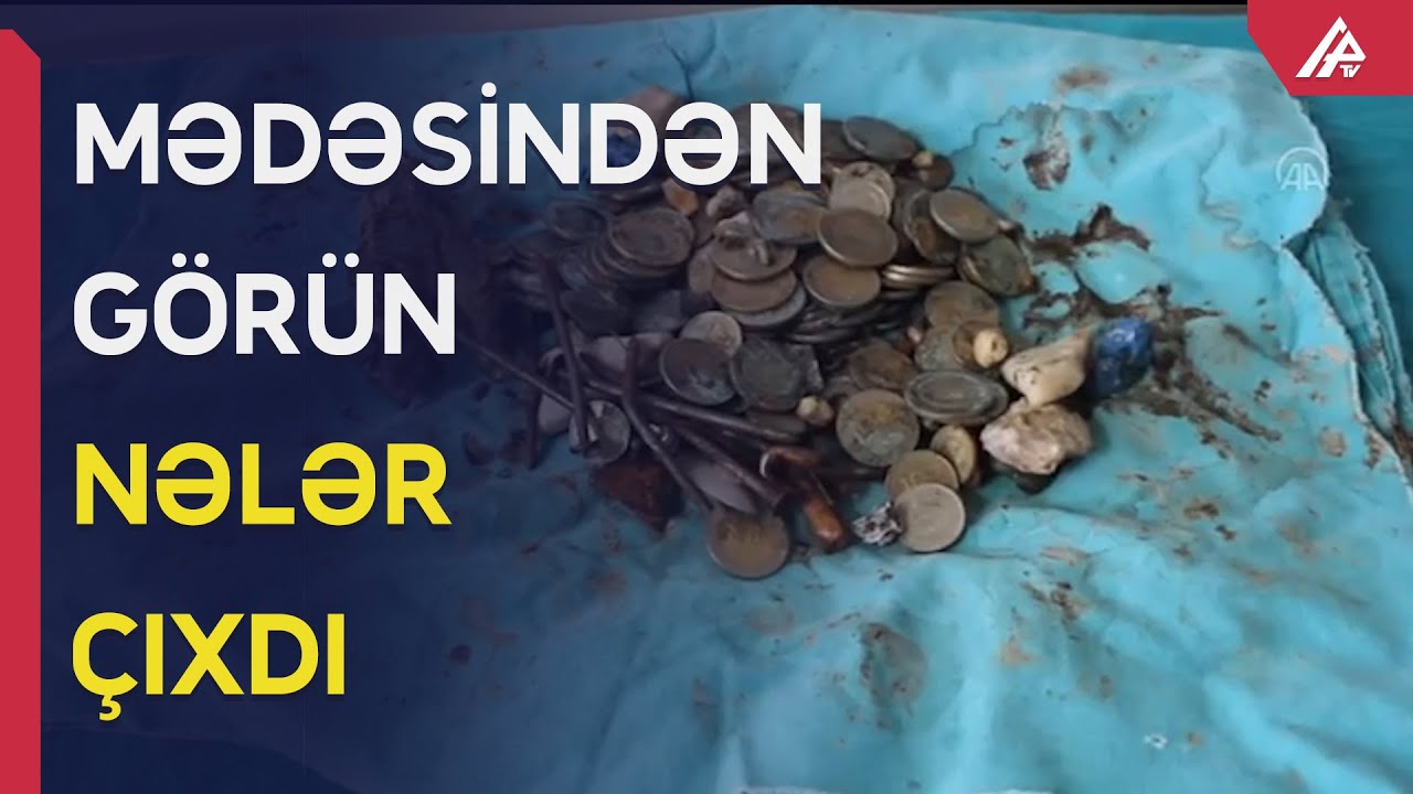 Kişinin mədəsindən 233 əşya çıxarıldı - Həkimlər şokda - APA TV