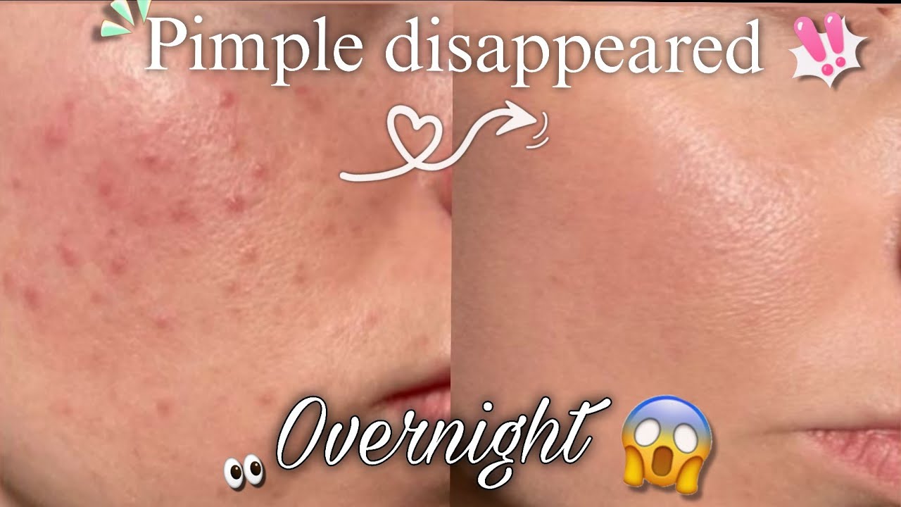 How to Remove pimples overnight at home | Acne treatment