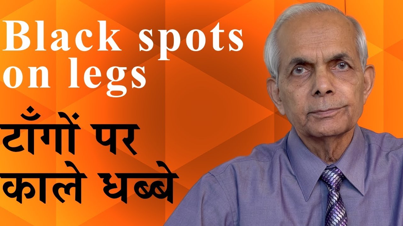 Black spots on legs/Pigmented Purpuric Dermatosis/टाँगों पर काले धब्बे