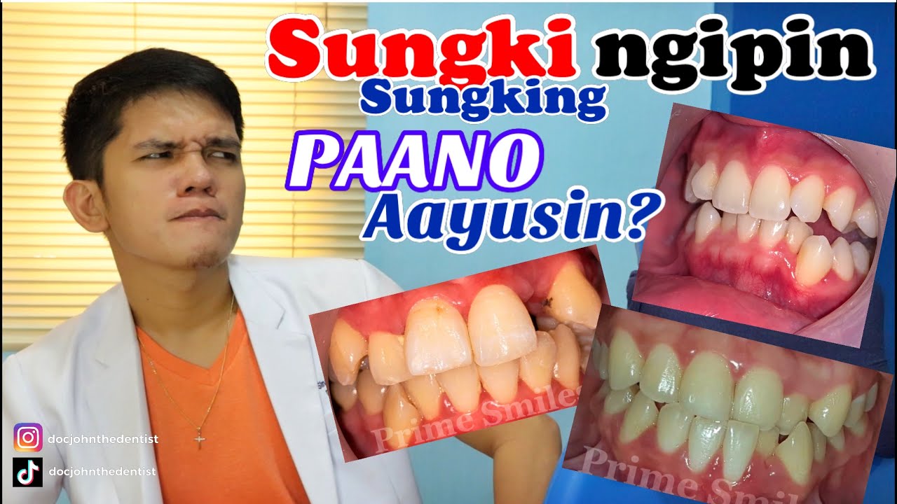 TEETH CROWDING: Sungki Sungking ipin, Paano inaayos ng braces?