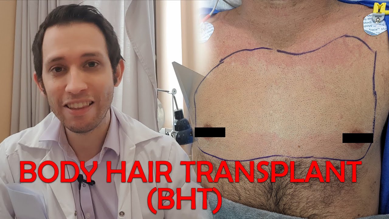 Body Hair Transplant (BHT) : trasplante de pelo corporal