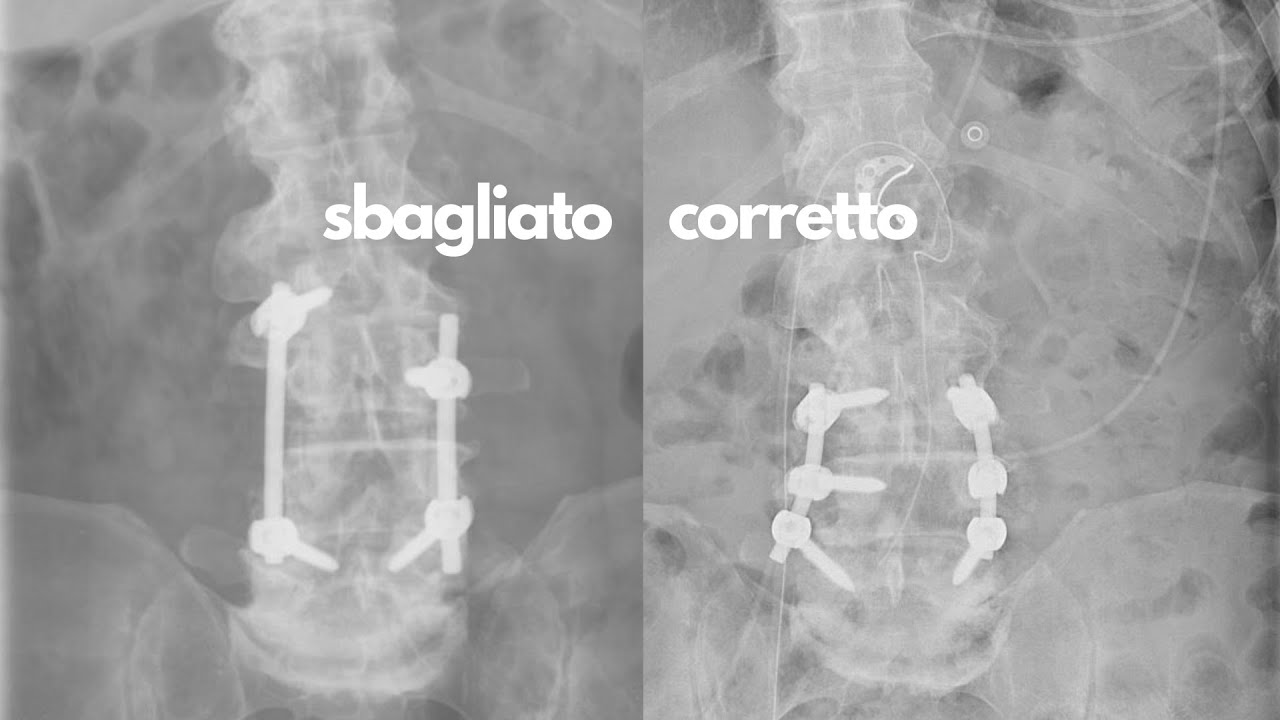 Avvocato per Malasanit&agrave;: Risarcimento per Errata Stabilizzazione della Colonna