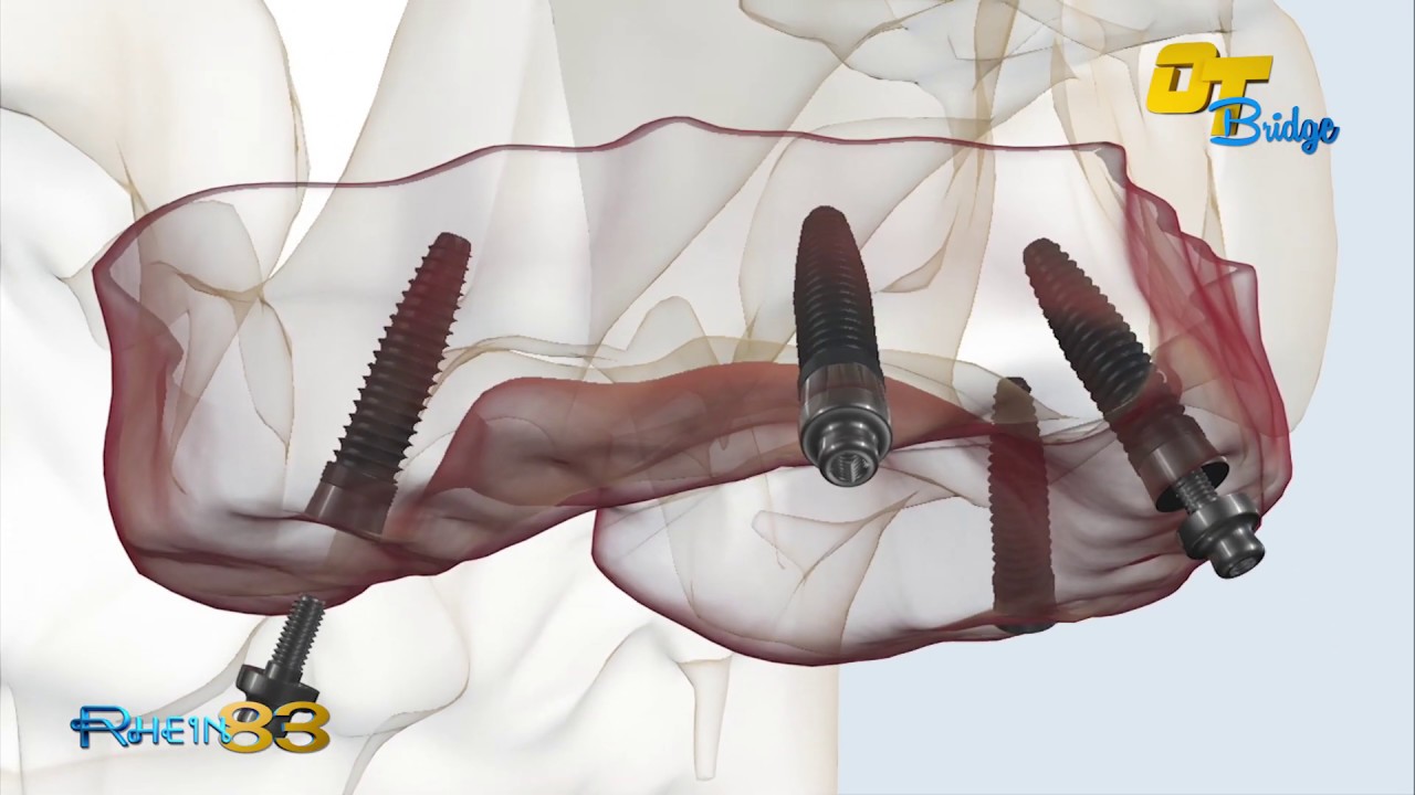 Rhein83 Fixed Prosthesis Ot Bridge Protesi Fissa