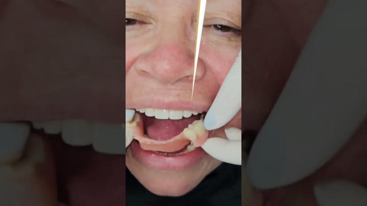 Prótesis grandes y pesadas? Ya no más! #byebye #protesisflexible #hollywoodveneers #protesisdental