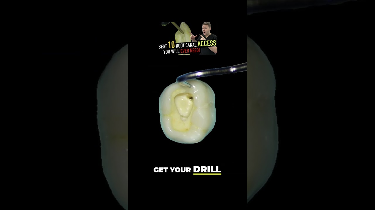 Преображение улыбок 😁 Освоение доступа к нижним молярам! 🦷