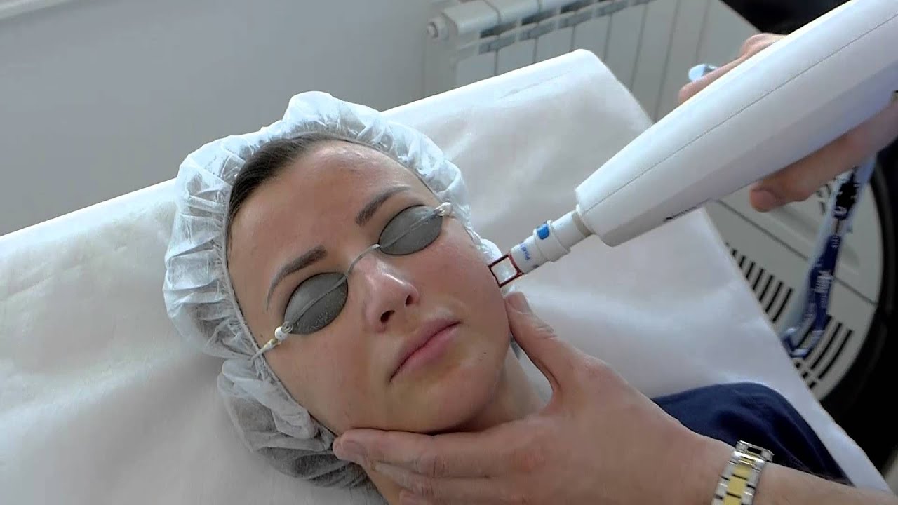 Tretman lica clear lift laserom -  Poliderma