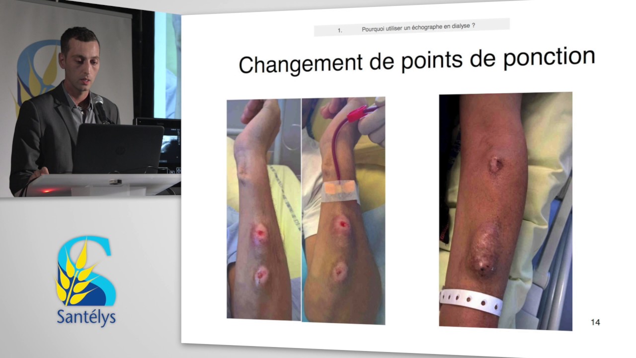 Surveillance de la FAV - Ponction sous échographie avec démonstration