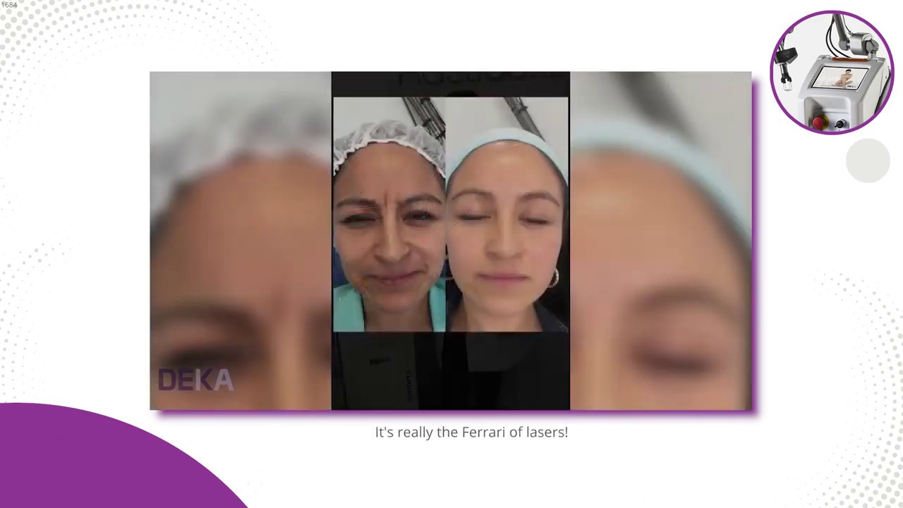 Dr. Dariela Capacho: SmartXide Punto, el Ferrari de los Láseres en Medicina Estética