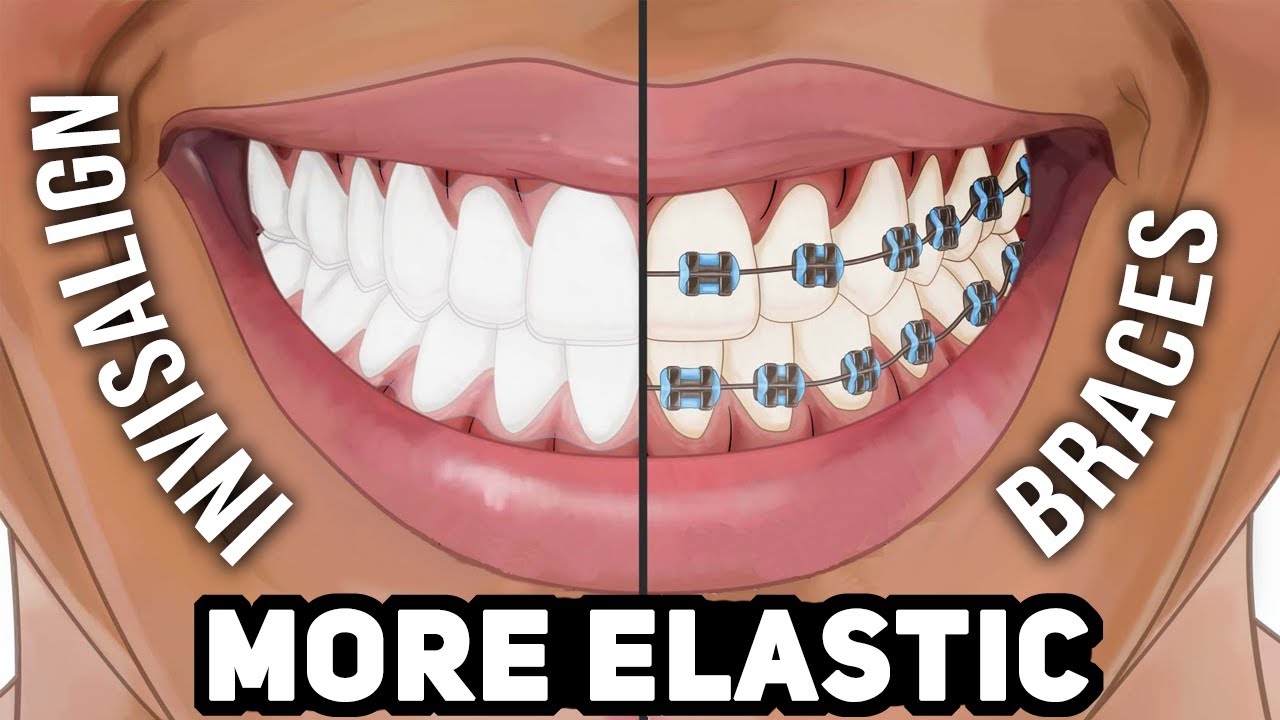 How Elastics Work Differently in Invisalign and ClearCorrect vs Braces