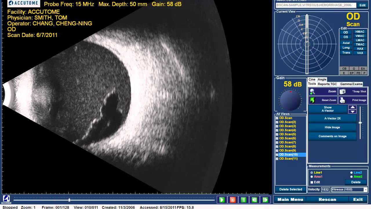 Accutome B-scan Plus - Vitreous Hemorrhage