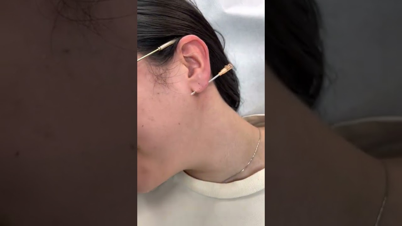 TRANSVERSE LOBE!