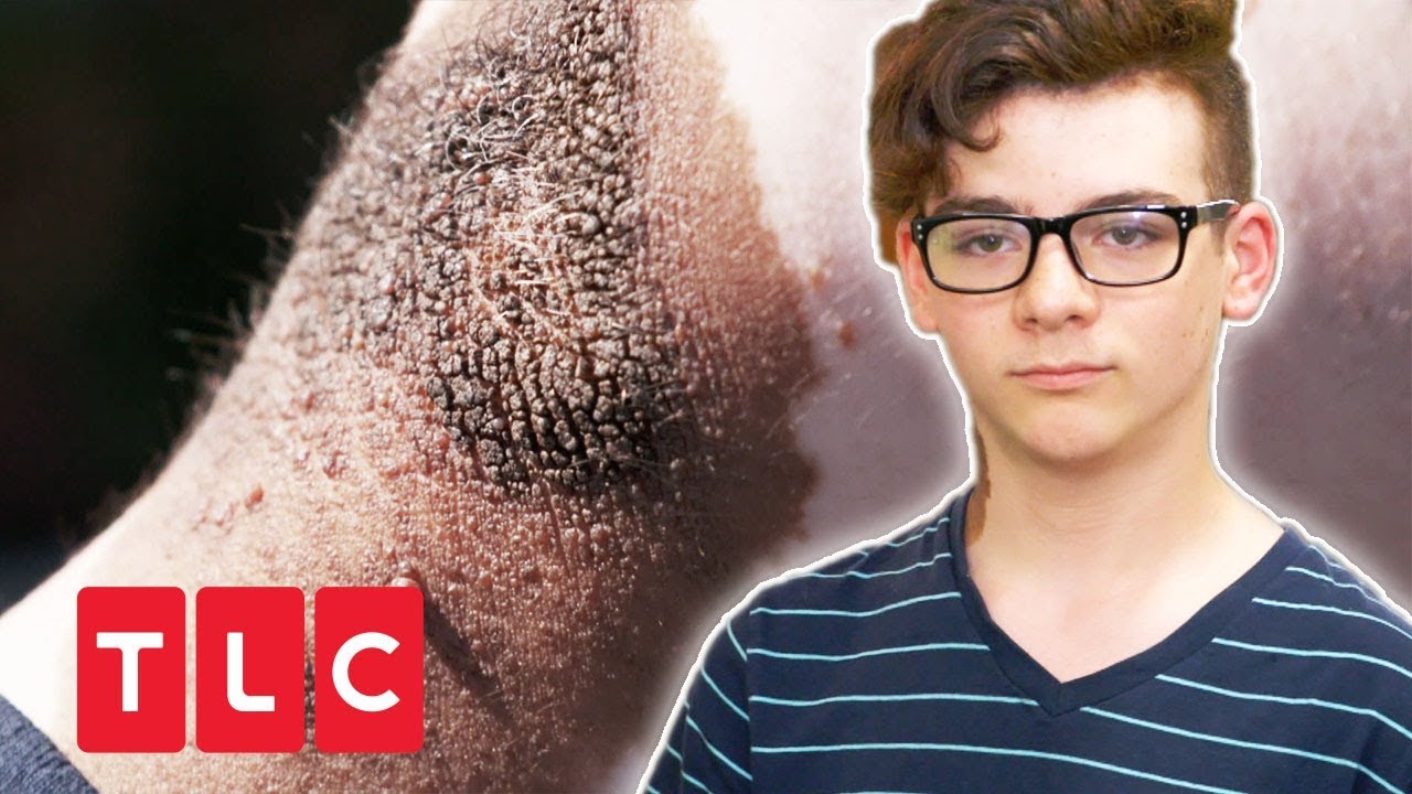 Riesiges Muttermal: Hat Vinnie Hautkrebs? | Dr. Pimple Popper | TLC Deutschland
