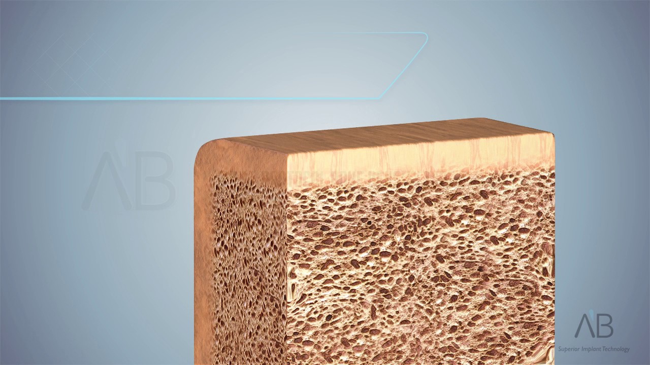 Drill protocol bone types 1 2 3 4