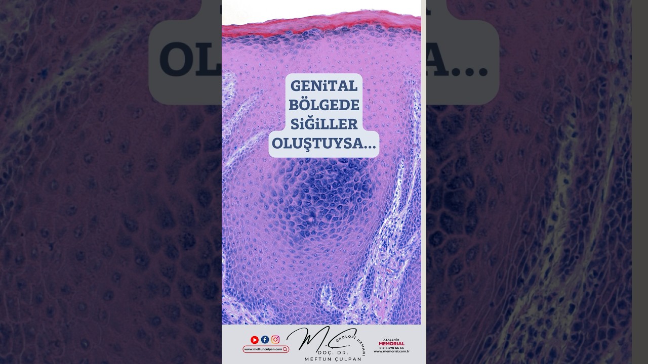 Genital b&ouml;lgede siğiller oluştuysa...