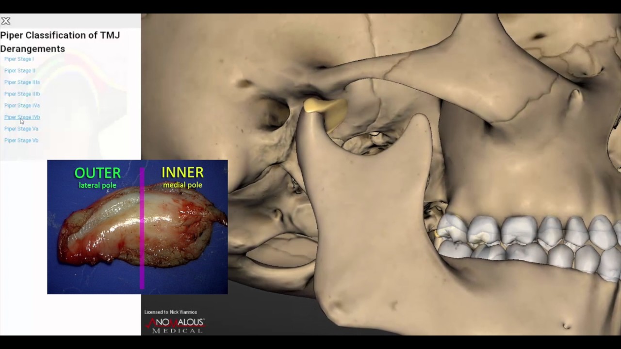 Piper classification video w disk overlay