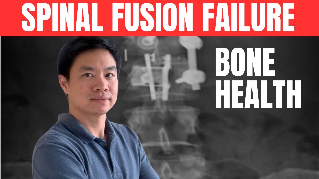 Spinal Fusion and Bone Health (The Hidden Risk)