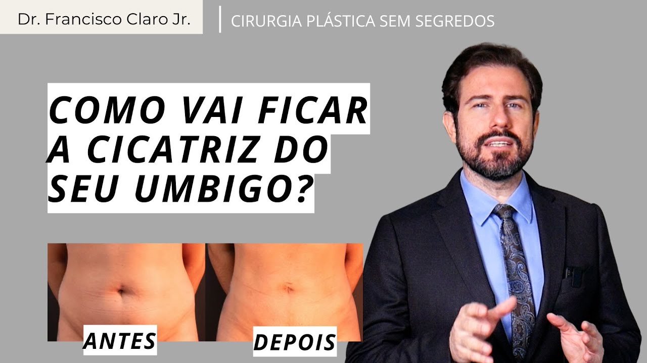 Como fica o meu umbigo após uma abdominoplastia ou lipoaspiração?
