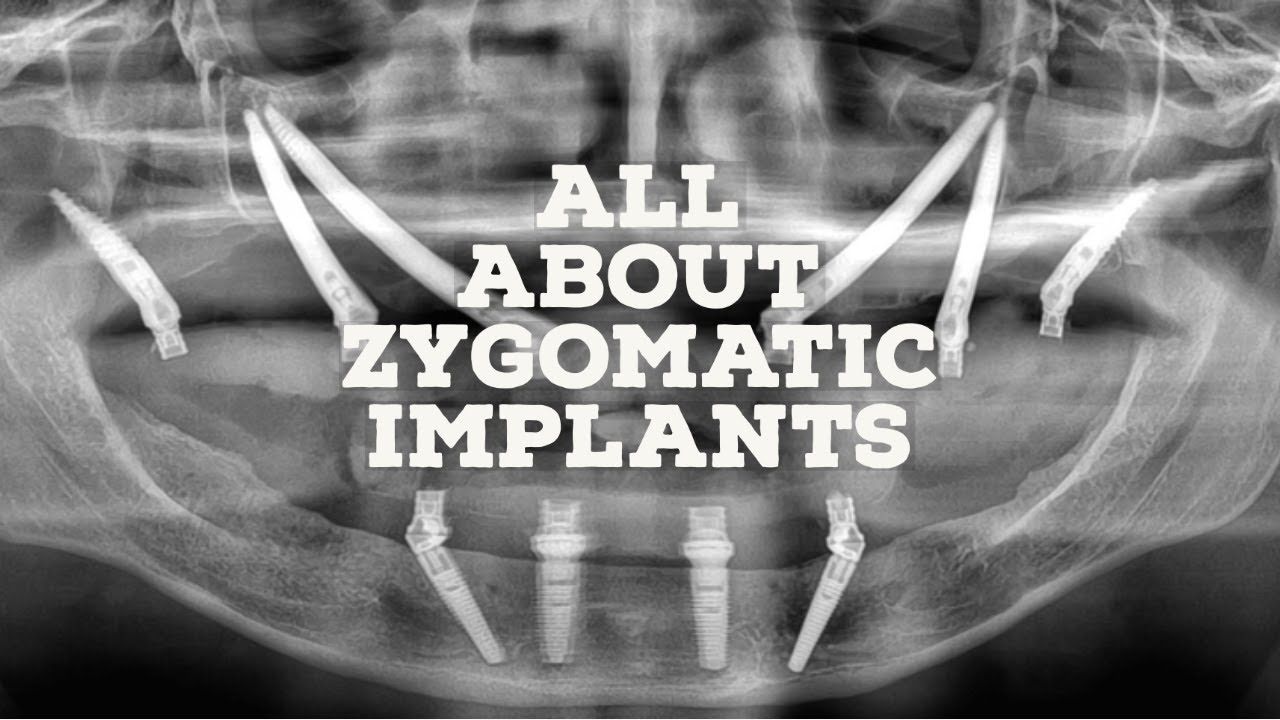 Everything You Need to Know About Zygomatic Implants | Find Out Why They May Work For You | AOMS