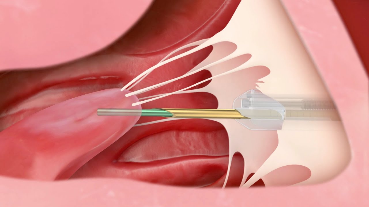 Transcatheter Mitral Valve Repair | Medical Animation